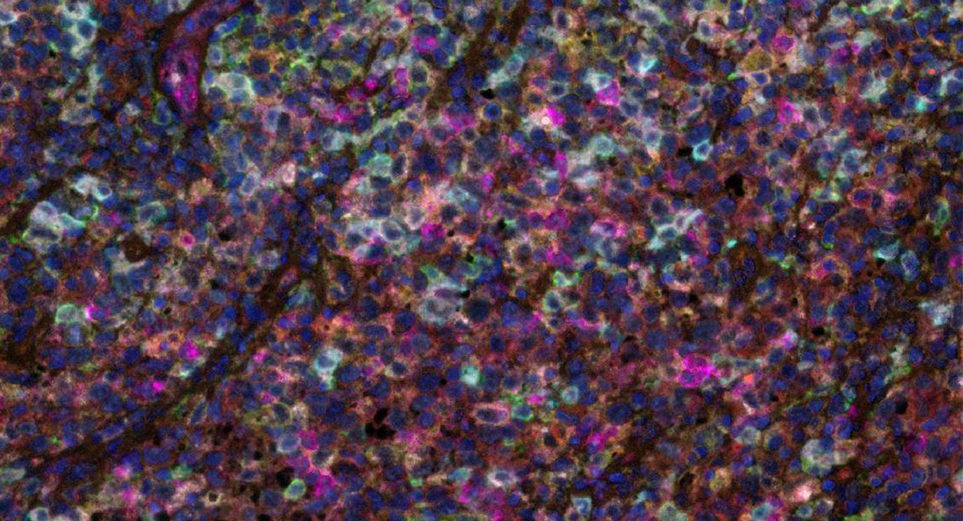 滤泡淋巴瘤细胞的病理图像