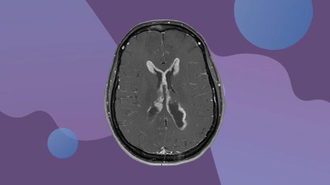 脑部扫描显示leptomeningeal疾病