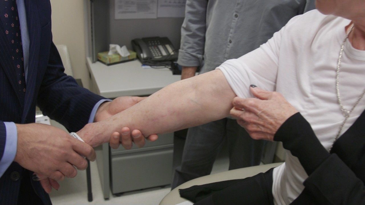 mphedema测试 Arm常见癌症处理副作用