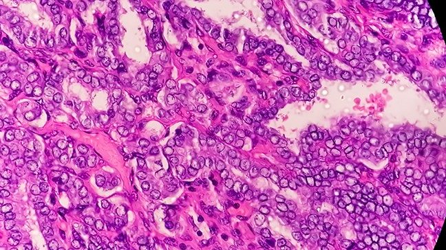 乳头状甲状腺癌的微观细胞着色色调明亮的粉红色和紫色的对比