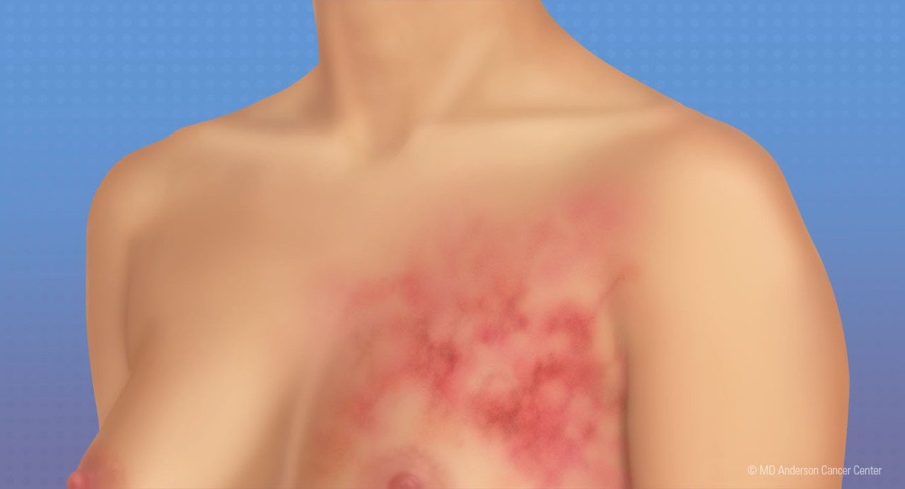 医学插图上胸部发炎性乳癌疹子和浅皮肤妇女蓝底乳房