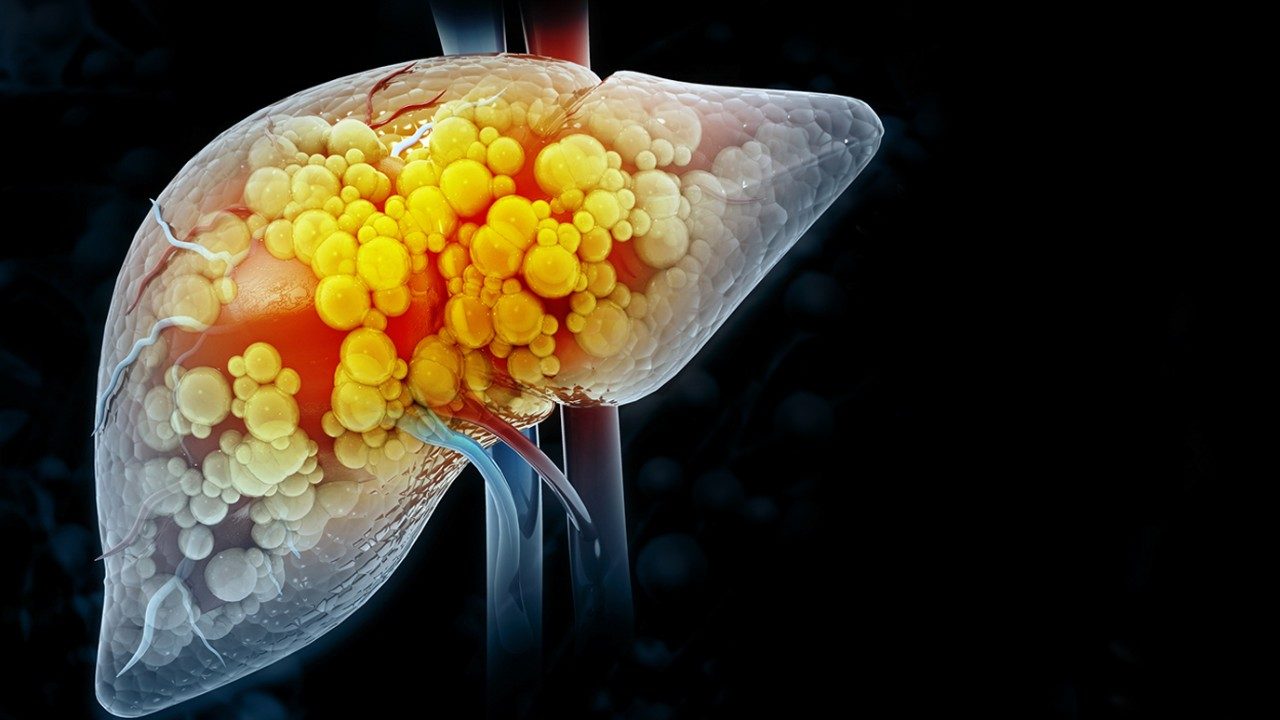 肝细胞癌的插图