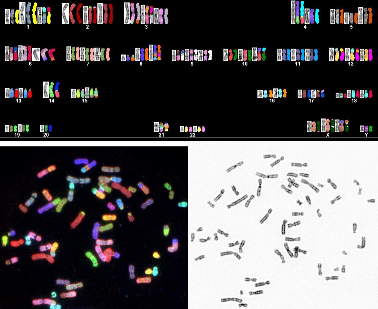 光谱核型分析分析(天空)表示复杂的癌症患者染色体异常