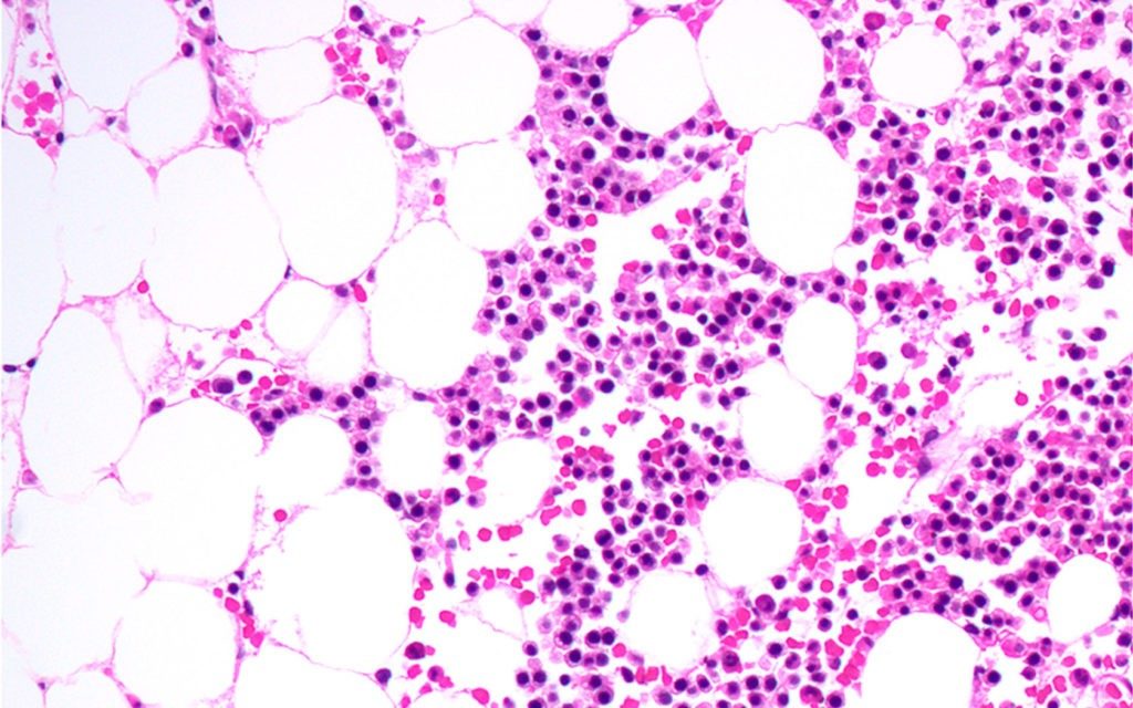 急性髓系白血病母细胞