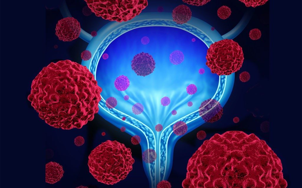 膀胱癌组合免疫疗法治疗临床试验