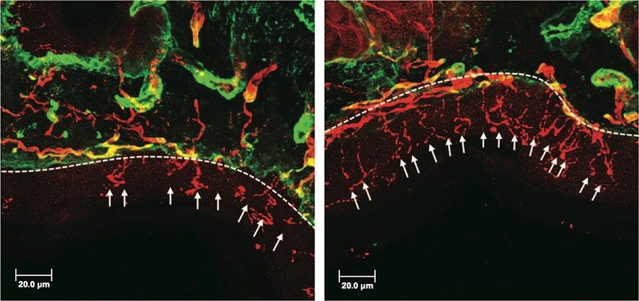 用对照载体（左）或HDAC6抑制剂ACY-1083（右）治疗的顺铂诱发神经病变小鼠爪子活检标本的显微照片显示，ACY-1083逆转了表皮内神经纤维（IENF）丢失，这是轴突病理学的早期指标。