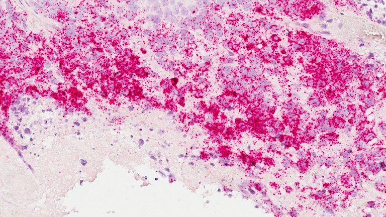 浸润性乳腺癌细胞