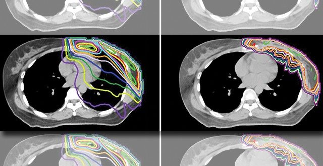 一名乳腺癌患者的乳房切除术后放疗计划显示，光子治疗(左)对心脏的平均剂量为3.63 Gy，而质子治疗(右)仅为0.05 Gy。图片由丽贝卡·豪厄尔医学博士提供