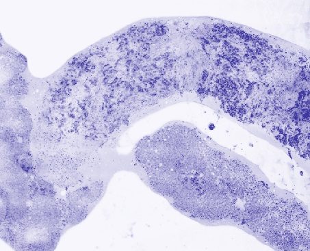 数字荧光共焦显微镜的伪色彩形象核心穿刺活检肝转移癌